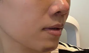 Bị 'thổi giá' nâng mũi từ 10 lên 205 triệu đồng vẫn gặp biến chứng Bị 'thổi giá' nâng mũi từ 10 lên 205 triệu đồng vẫn gặp biến chứng